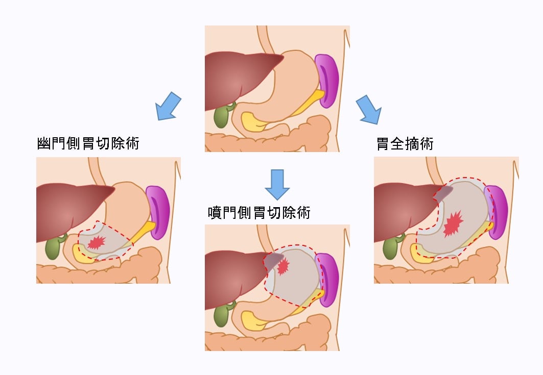 各術式における胃の切除範囲(例)